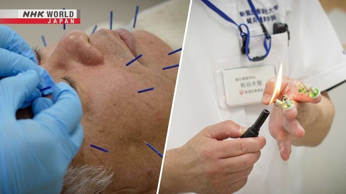 Acupuncture to Improve Quality of Life