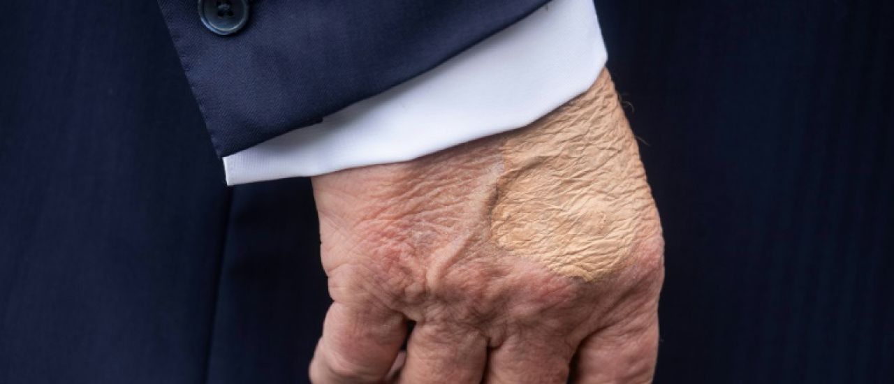 Trump souffre d'insuffisance veineuse, après avoir fait état de jambes enflées
