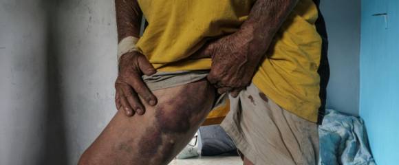 Hilario Reynosa montre les bleus sur ses cuisses, le 15 octobre 2025 à Poza Rica, après avoir survécu avec sa femme Elodia Reyes aux inondations dans le quartier de Morelos, piégés par le débordement de la rivière Cazones, dans l'État de Veracruz, au Mexique Hilario Reynosa montre les bleus sur ses cuisses, le 15 octobre 2025 à Poza Rica, après avoir survécu avec sa femme Elodia Reyes aux inondations dans le quartier de Morelos, piégés par le débordement de la rivière Cazones, dans l'État de Veracruz, au Mexique